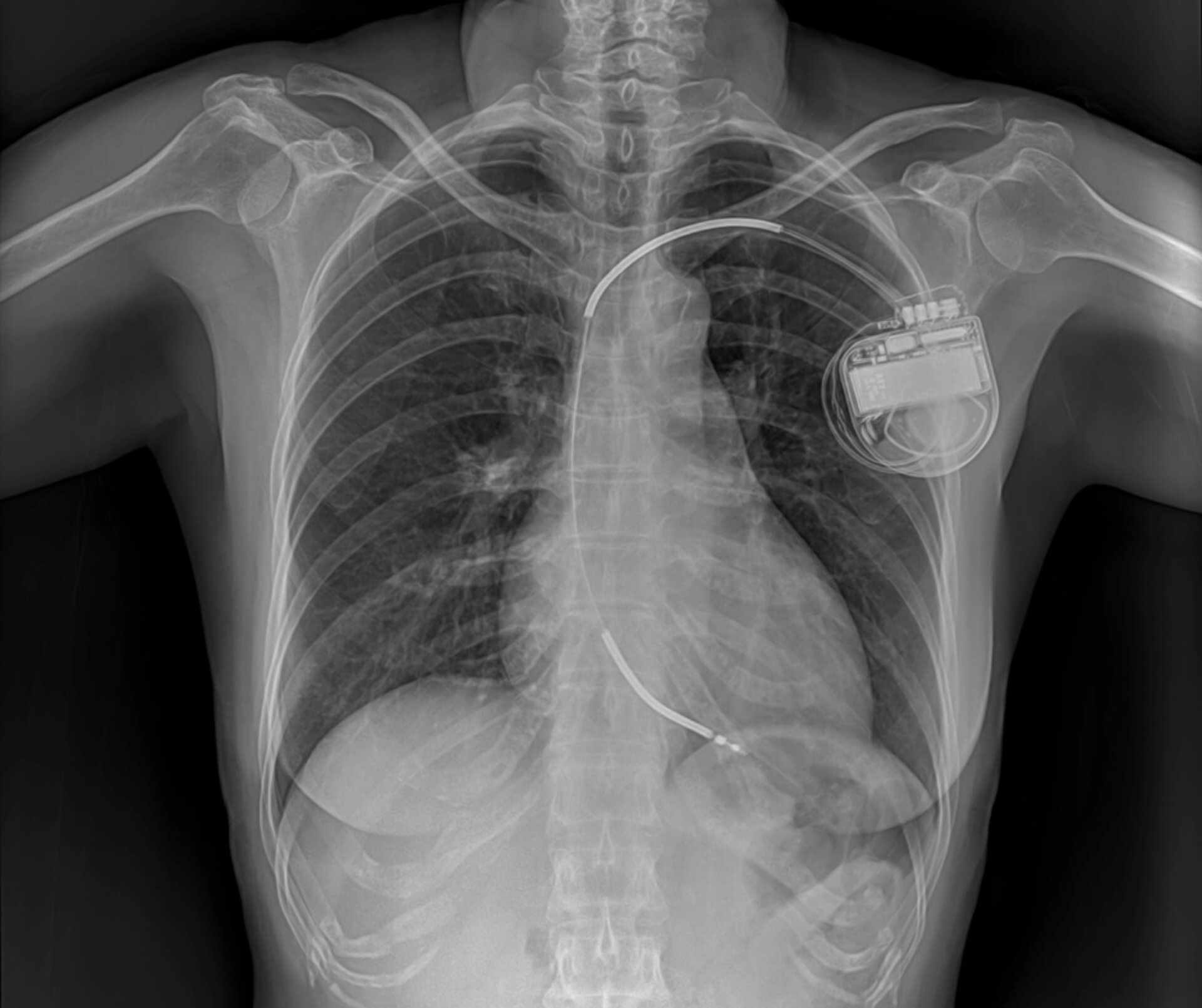Pacemaker &amp; AICD Implantation